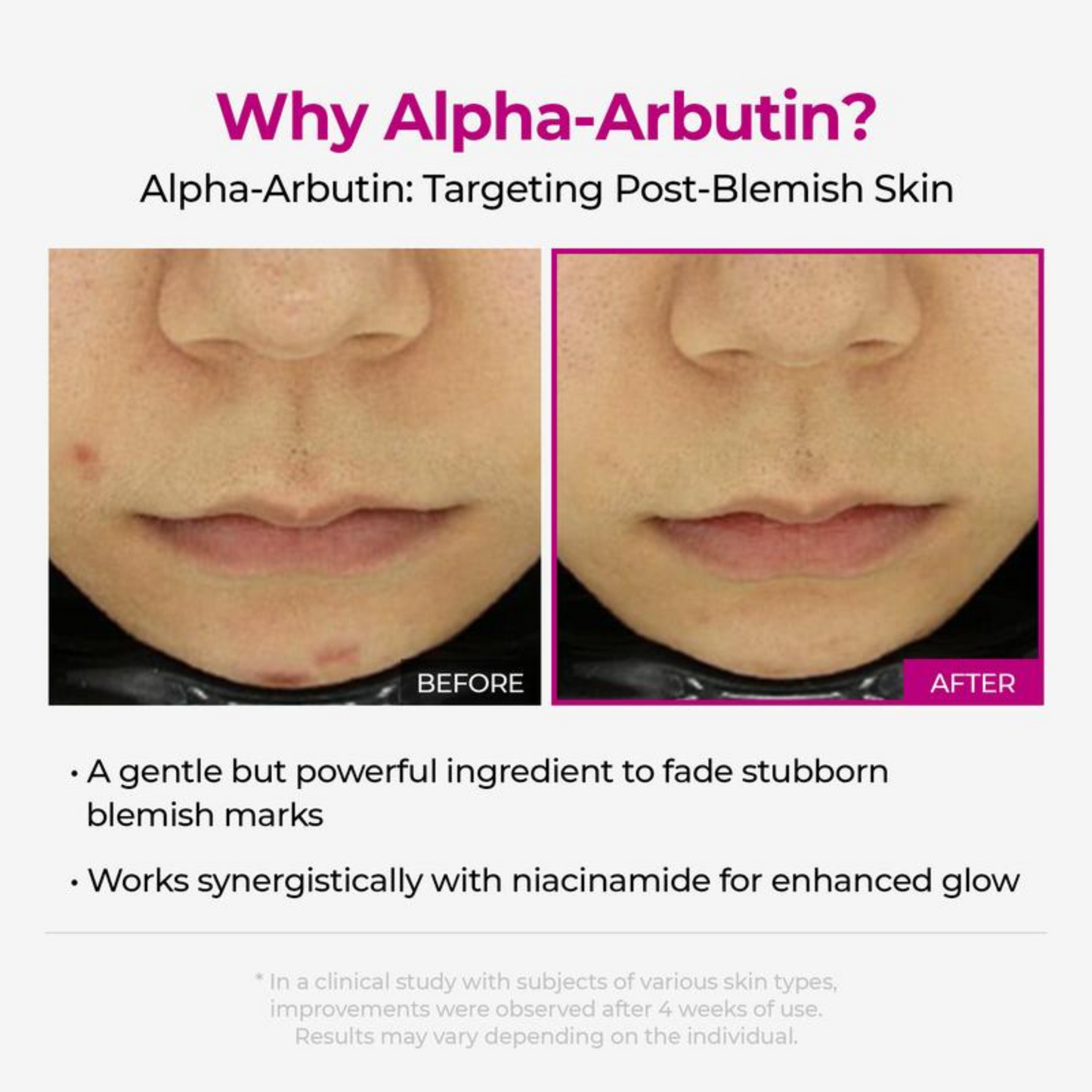 PoreFade™ Set | Shrinks Pores & Fades Blemish