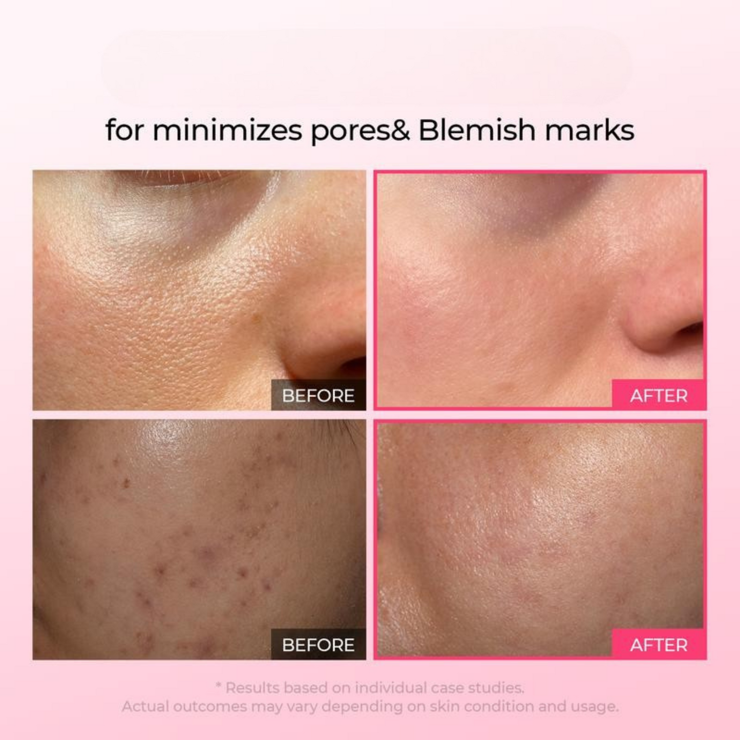PoreFade™ Set | Shrinks Pores & Fades Blemish